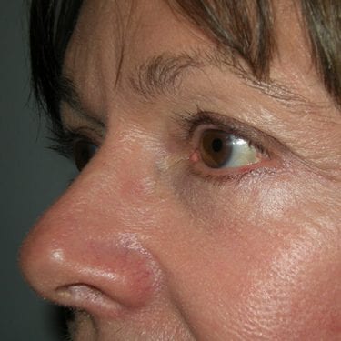 Brow Lift Patient 09 - After 