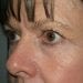 Brow Lift Patient 09 - Before Thumbnail 