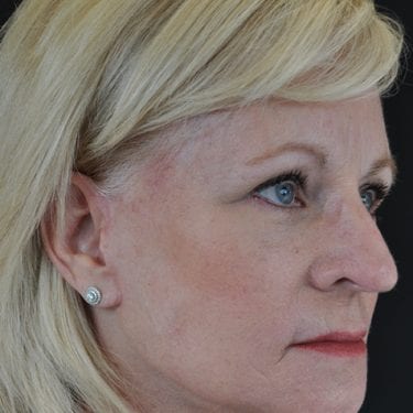 Brow Lift Patient 02 - After 