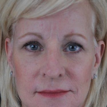 Brow Lift Patient 02 - Before 