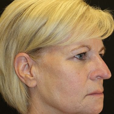 Brow Lift Patient 02 - Before 