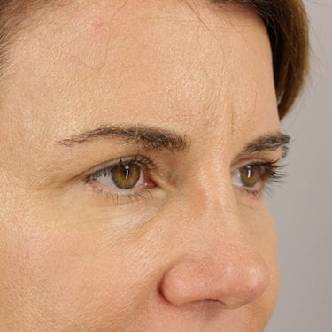 Brow Lift Patient 03 - After 