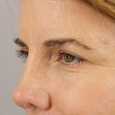 Brow Lift Patient 03 - After 