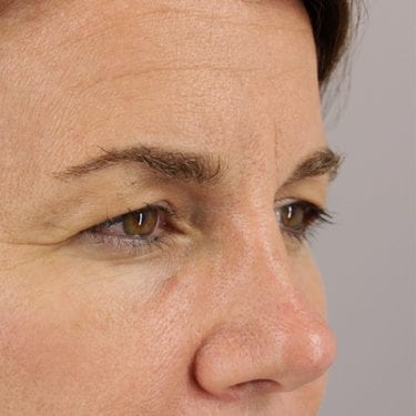 Brow Lift Patient 03 - Before 