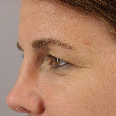 Brow Lift Patient 03 - Before 
