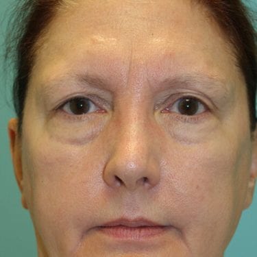 Brow Lift Patient 04 - Before 