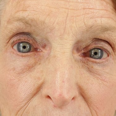 Brow Lift Patient 05 - After 2