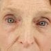 Brow Lift Patient 05 - After Thumbnail 