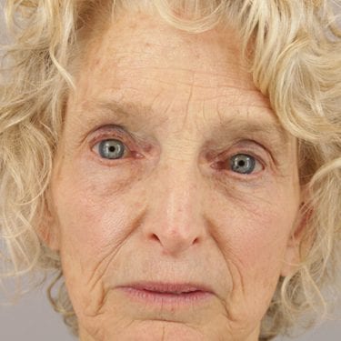 Brow Lift Patient 05 - After 