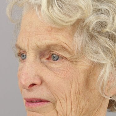 Brow Lift Patient 05 - After 