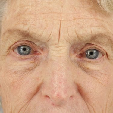 Brow Lift Patient 05 - Before 2