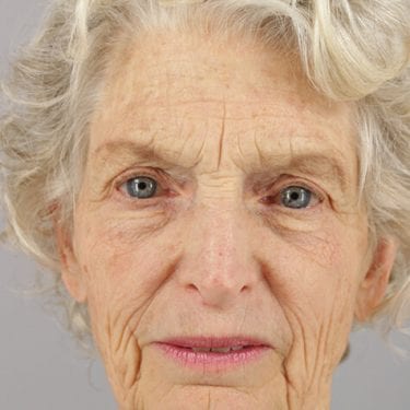 Brow Lift Patient 05 - Before 