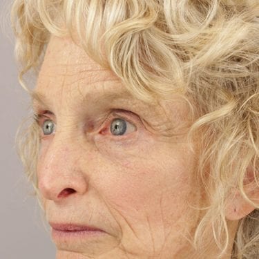 Brow Lift Patient 05 - Before 