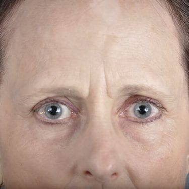 Brow Lift Patient 06 - Before 