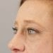 Brow Lift Patient 07 - After Thumbnail 