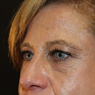 Brow Lift Patient 07 - Before 