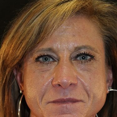 Brow Lift Patient 07 - Before 