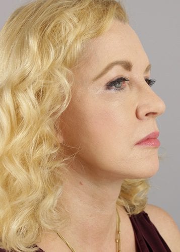 Face Lift Patient 13 - After 