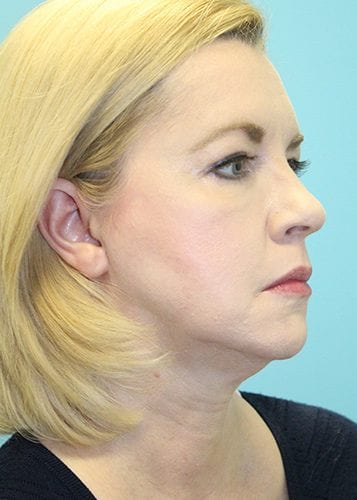 Face Lift Patient 13 - Before 