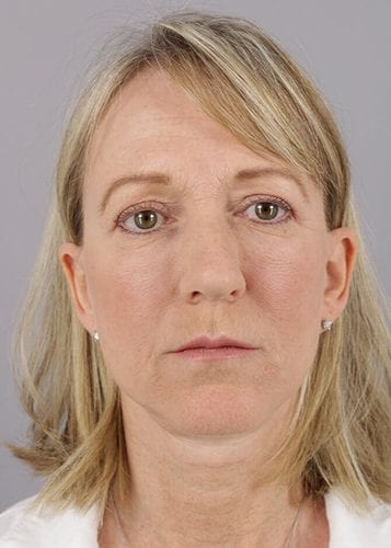 Face Lift Patient 10 - After 