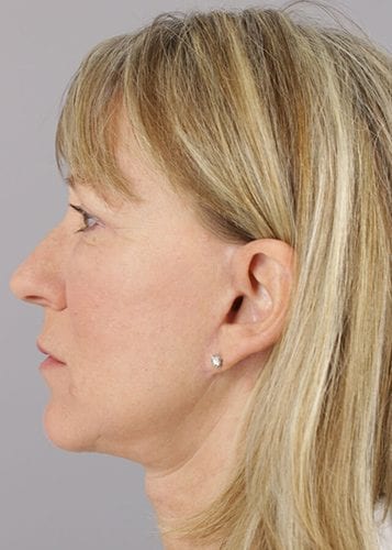 Face Lift Patient 10 - After 