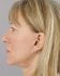 Face Lift Patient 10 - After Thumbnail 
