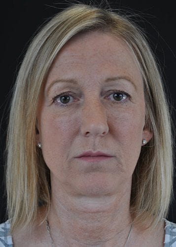 Face Lift Patient 10 - Before 