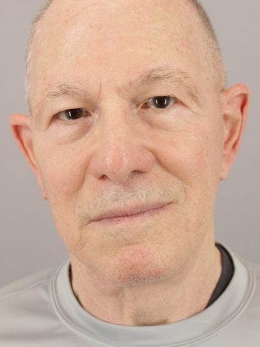 Face Lift Patient 12 - After 