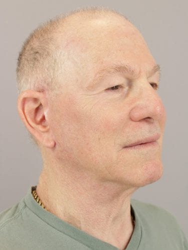 Face Lift Patient 12 - After 