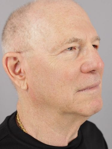 Face Lift Patient 12 - Before 