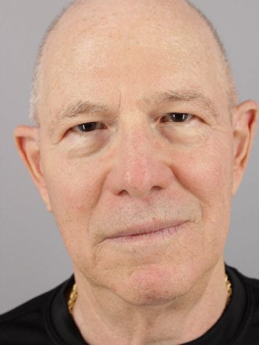 Face Lift Patient 12 - Before 