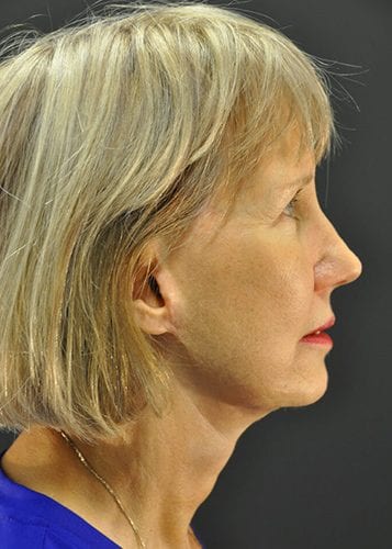 Face Lift Patient 14 - After 