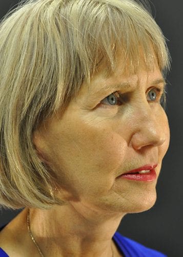 Face Lift Patient 14 - After 