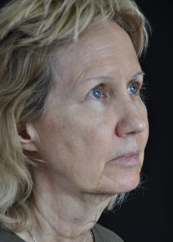 Face Lift Patient 14 - Before 