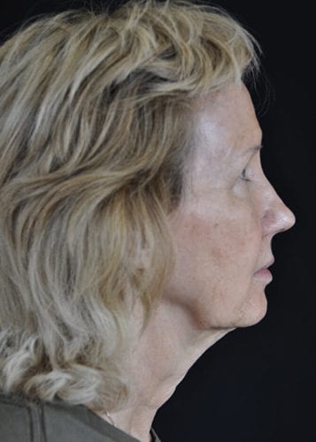 Face Lift Patient 14 - Before 