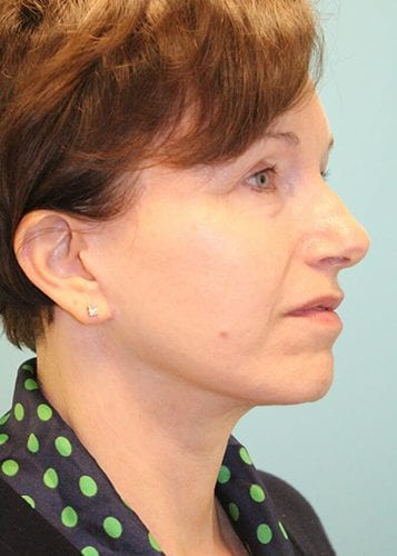 Face Lift Patient 15 - After 