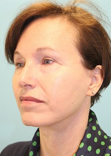 Face Lift Patient 15 - After 