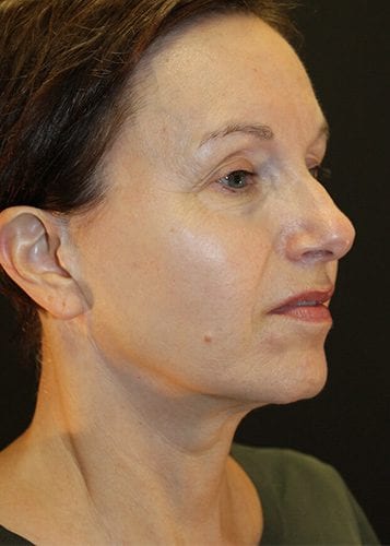 Face Lift Patient 15 - Before 