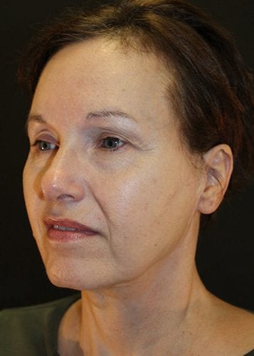 Face Lift Patient 15 - Before 