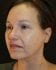 Face Lift Patient 15 - Before Thumbnail 
