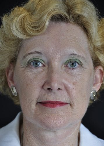 Face Lift Patient 16 - After 