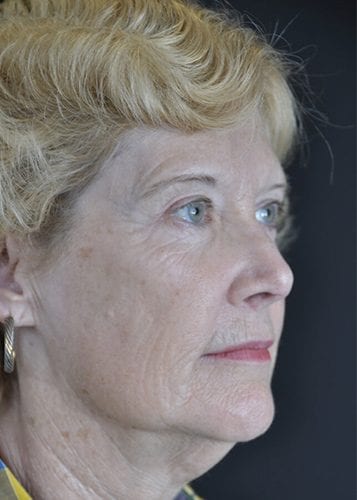 Face Lift Patient 16 - Before 