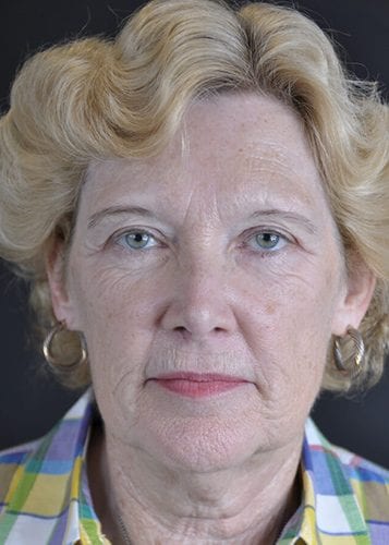 Face Lift Patient 16 - Before 