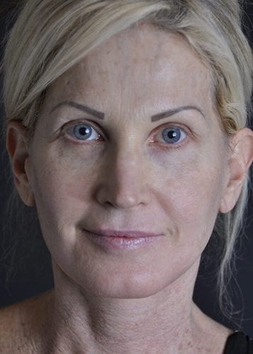 Face Lift Patient 17 - After 