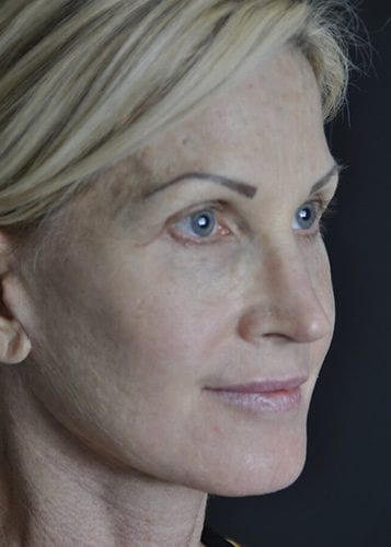 Face Lift Patient 17 - After 