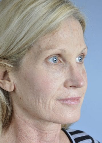 Face Lift Patient 17 - Before 