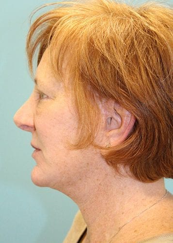 Face Lift Patient 18 - Before 