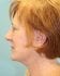 Face Lift Patient 18 - Before Thumbnail 