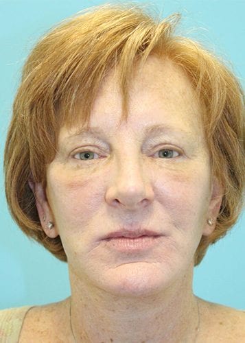 Face Lift Patient 18 - Before 