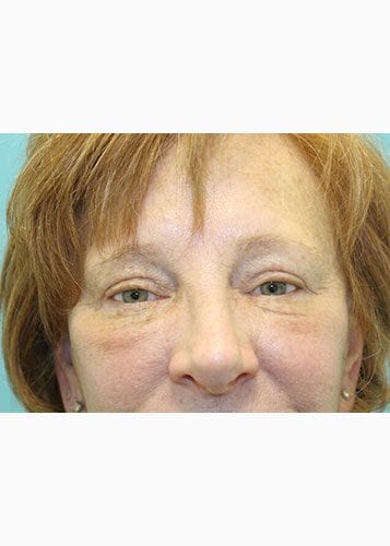 Face Lift Patient 18 - Before 2